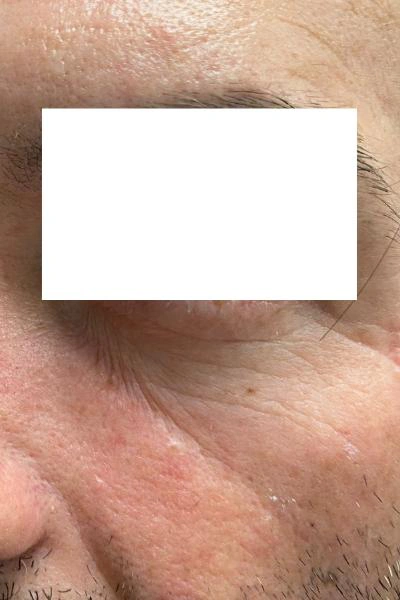 Antes — Eliminacion de ojeras 1 - Antes