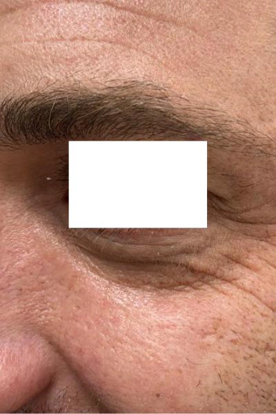 Antes — Eliminacion de ojeras 2 - Antes