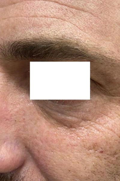 Eliminación de ojeras