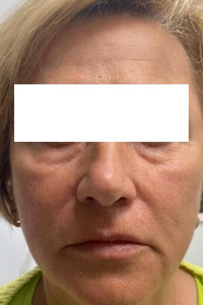 Antes — Eliminacion de ojeras 1 - Antes