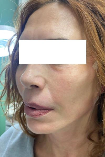 Después — Flacidez facial 3 - Antes