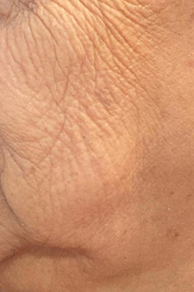 Antes — Skinbooster 2 - Antes