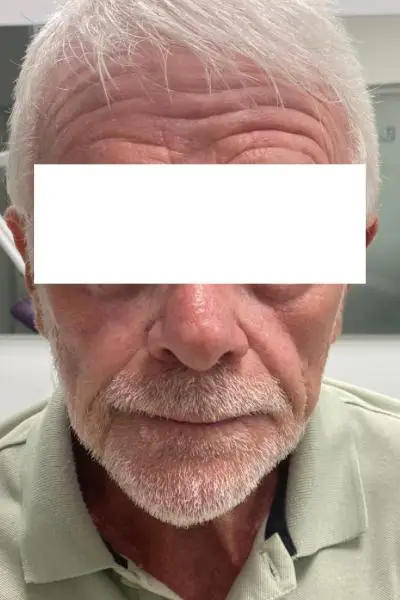 Antes — estimuladores de colageno 2 ante