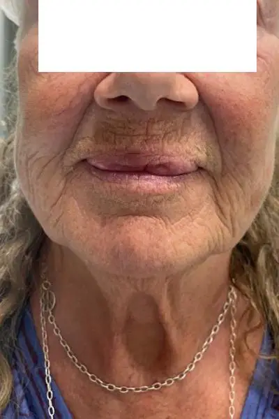 Antes — estimuladores de colageno 4 antes