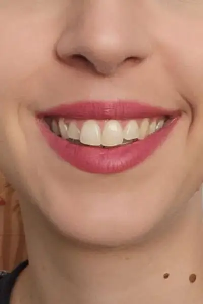 Después — sonrisa gingival 1 antes