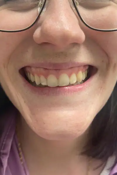 Antes — sonrisa gingival 2 antes