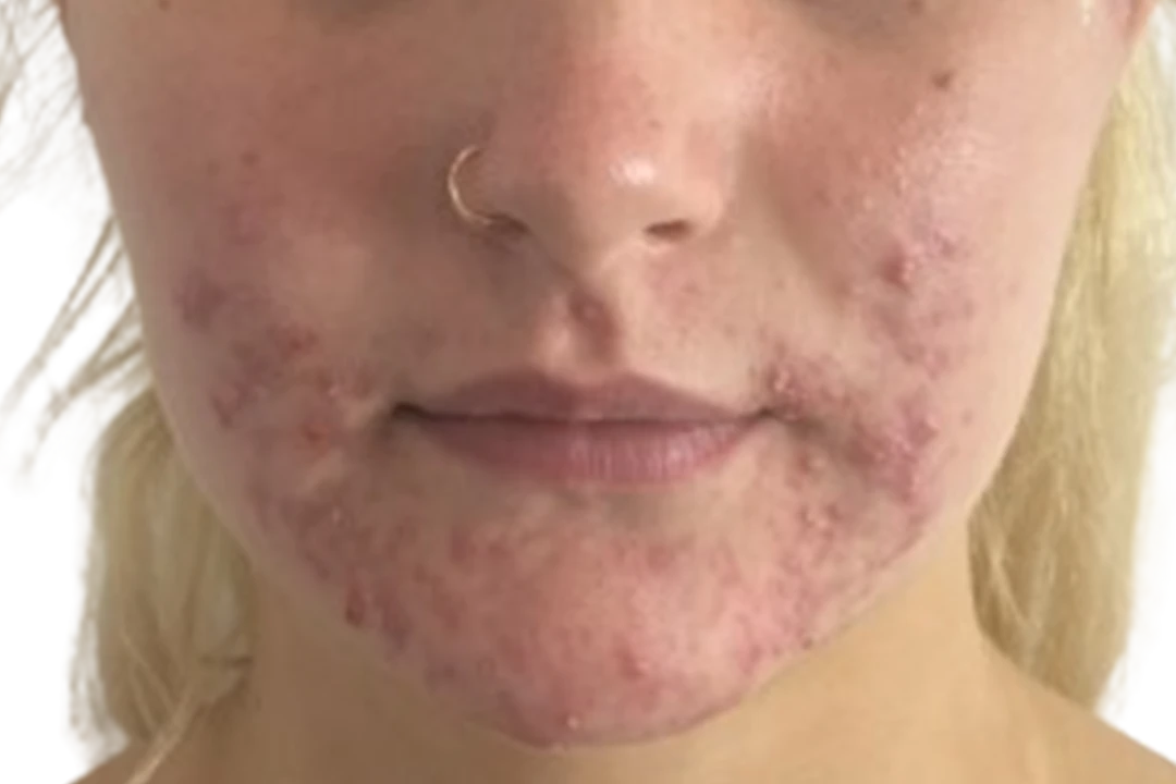 Antes — Dermapen 4 – Acné