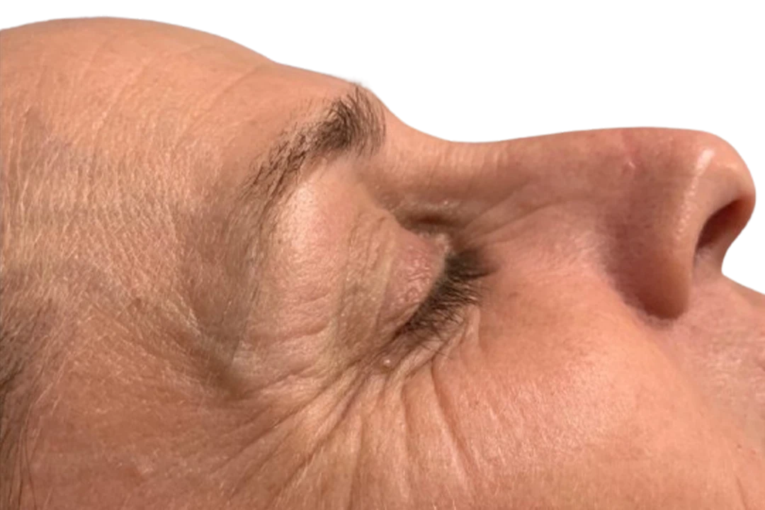 Antes — Dermapen 4 – Arrugas finas