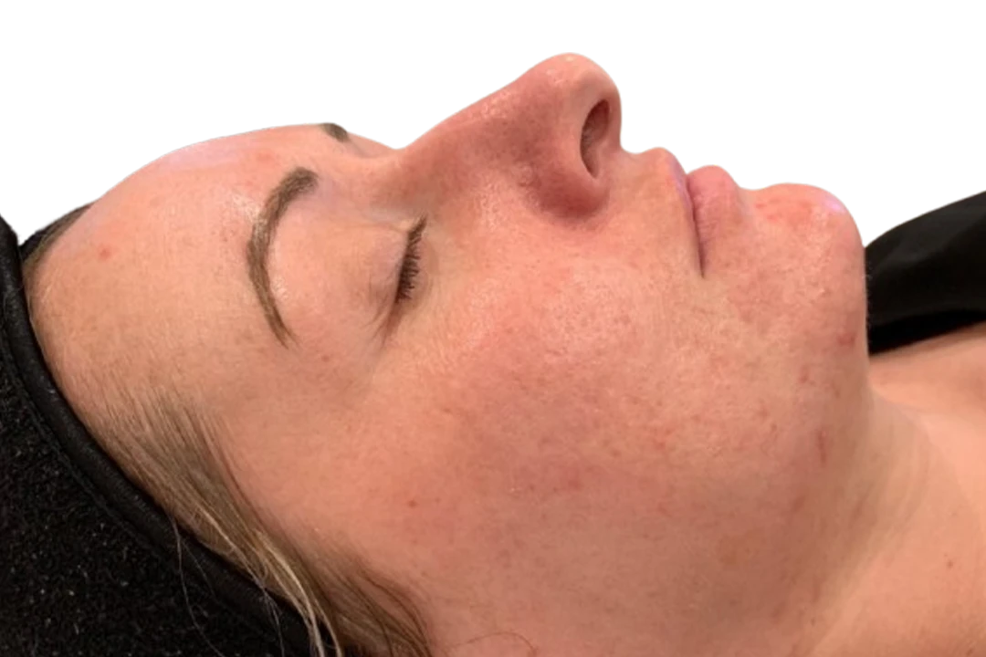Después — Dermapen 4 – Cicatrices