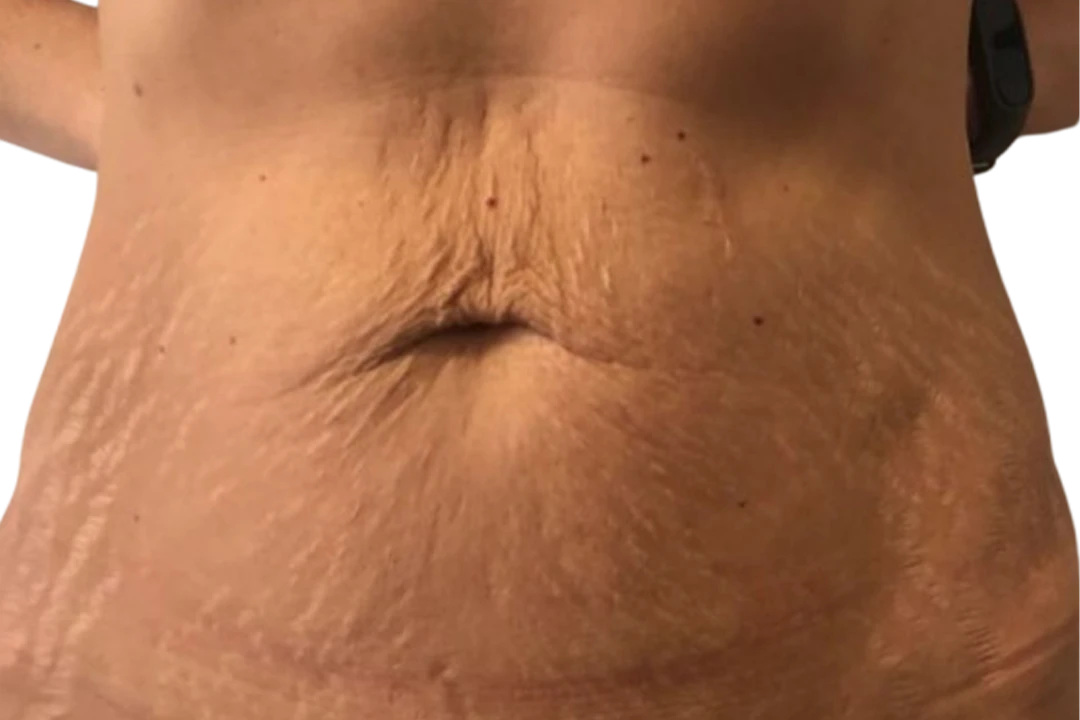 Antes — Dermapen 4 – Estrías