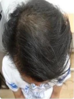 Før — Indiba capilar – densidad del cabello