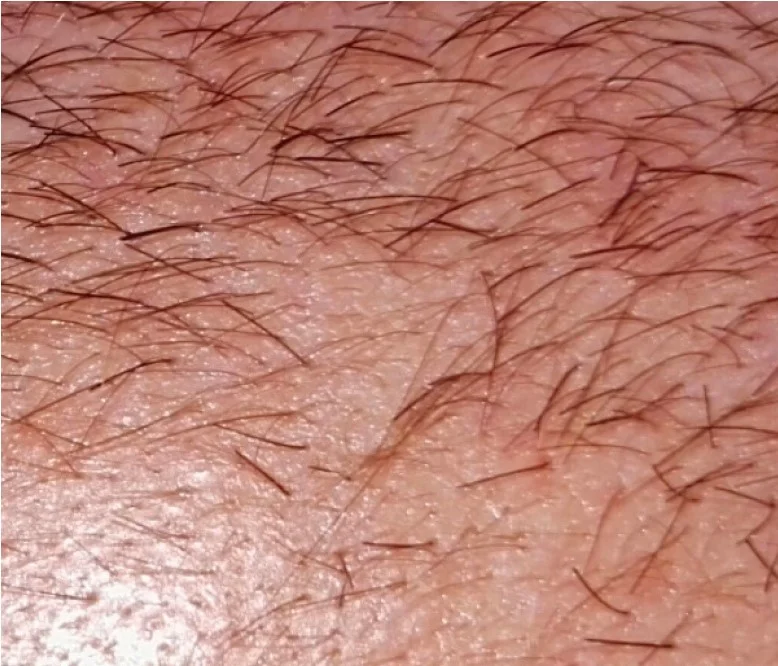 Før — Indiba capilar – redensificación vista al microscopio